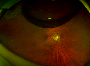 수술 후 7일 사진